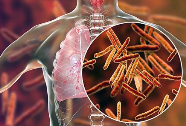 Tuberculosis and comorbidities